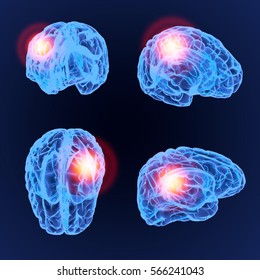 Headache X-Ray 3D model. Brain neurons synapse, anatomy body. Set of medical illustration of disease, head pain. 