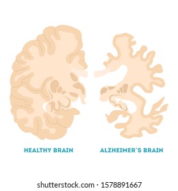 Healthy And Alzheimer Brain. Neurodegeneration Concept. Brain Disease, Memory Loss. Isolated  Illustration In Cartoon Style