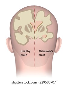 Healthy Brain Vs. Alzheimer's Brain