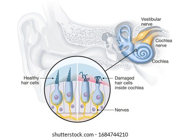 Healthy and damaged hair cells inside cochlea