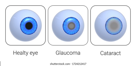 Healthy Eye, Glaucoma, Cataract. Eye Deseases. Isolated On White. 3D-rendering. 