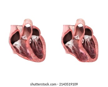 healthy heart versus aneurysm,heart anatomy, Left ventricular aneurysm, wall bulge, transmural damage, develops, dislocation, aneurysm formation, rupture, thrombus embolism illustration 3d render