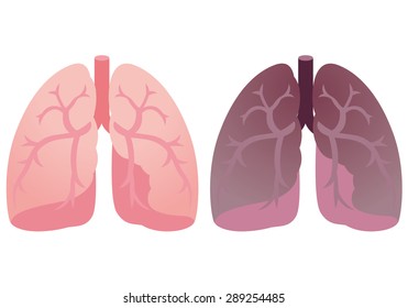 Healthy Lung And Damage Lung