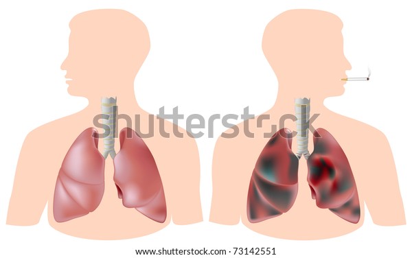健康な肺と腫瘍のある喫煙者の肺 のイラスト素材