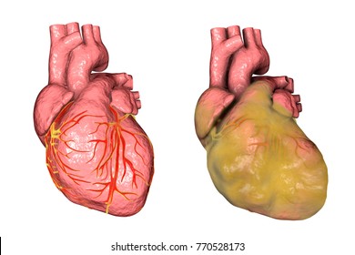 Healthy And Obese Heart With Left Ventricular Hypertrophy Isolated On White Background, 3D Illustration