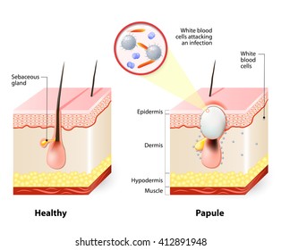 3,657 Acne dermis Images, Stock Photos & Vectors | Shutterstock