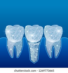 Healthy Teeth And Dental Implant. Dentistry. Implantation Of Human Teeth. Polygonal Wireframe From Dots And Lines, Abstract Design. Digital Graphics  Illustration. For Poster, Cover, Label, Sticker