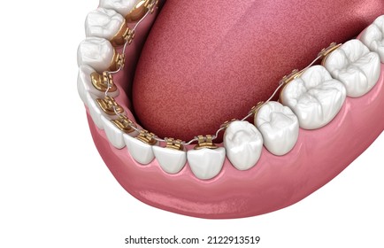 Healthy Teeth With Gold Braces, Dental 3D Illustration