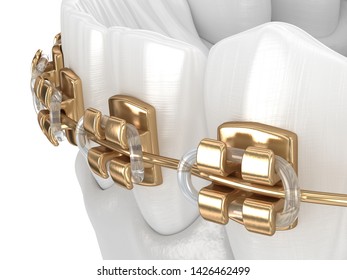 Healthy Teeth With Gold Braces, White Teeth Concept, Dental 3D Illustration