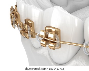 Healthy Teeth With Gold Braces, White Teeth Concept, Dental 3D Illustration