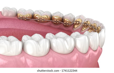 Healthy Teeth With Gold Braces, White Teeth Concept, Dental 3D Illustration