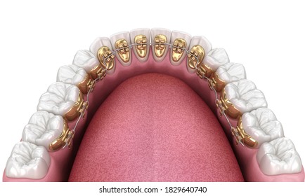 Healthy Teeth With Gold Braces, White Teeth Concept, Dental 3D Illustration