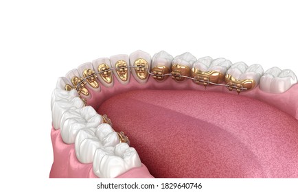 Healthy Teeth With Gold Braces, White Teeth Concept, Dental 3D Illustration