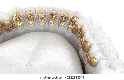 Healthy Teeth With Gold Braces, White Style Concept, Dental 3D Illustration