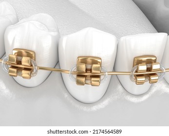 Healthy Teeth With Gold Braces, White Style Concept, Dental 3D Illustration