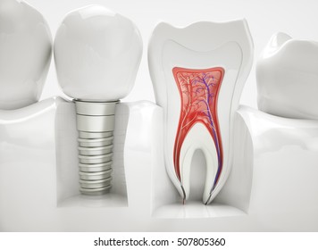 Healthy teeth and an implant - 3d rendering
