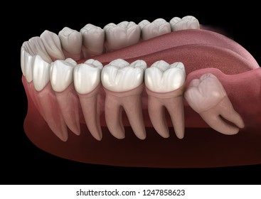 Healthy teeth and wisdom tooth with mesial impaction . Medically accurate tooth 3D illustration