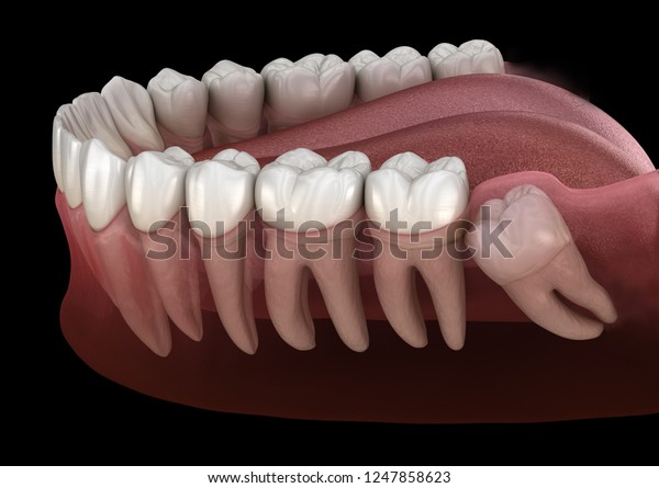 Healthy teeth and wisdom tooth with\
mesial impaction . Medically accurate tooth 3D\
illustration