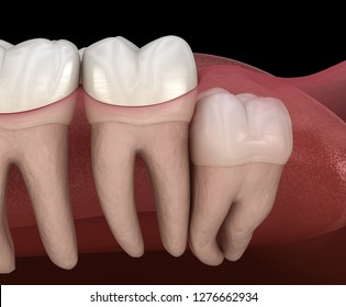 Healthy Teeth And Wisdom Tooth With Vertical Impaction . Medically Accurate Tooth 3D Illustration