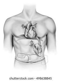 Heart - Artificial Heart Pump Shown Are The Electronic Controller, Implanted Batteries, Blood Pump, Energy Converter, Inflow Graft, And Outflow Graft.