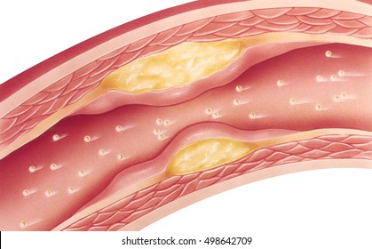 Heart - Atherosclerosis - Severe. Vascular atherosclerosis cutaway view of accumulated plaque in an afflicted blood vessel. This condition is entirely avoidable and reversible with a plant based diet.