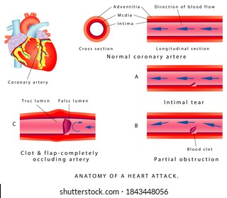 Heart Attack Anatomy Heart Attack Heart Stock Illustration 1843448056 ...