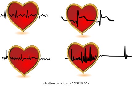 Heart Attack Normal Atrial Fibrillation Arrhythmia 3d Infarction