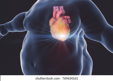 Heart Attack In A Person With Obesity, Conceptual Image. 3D Illustration