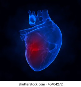 Heart Attack Xray View