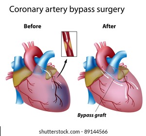 Heart Bypass Surgery