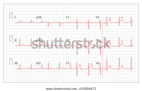 Healthy Heart Beat Chart
