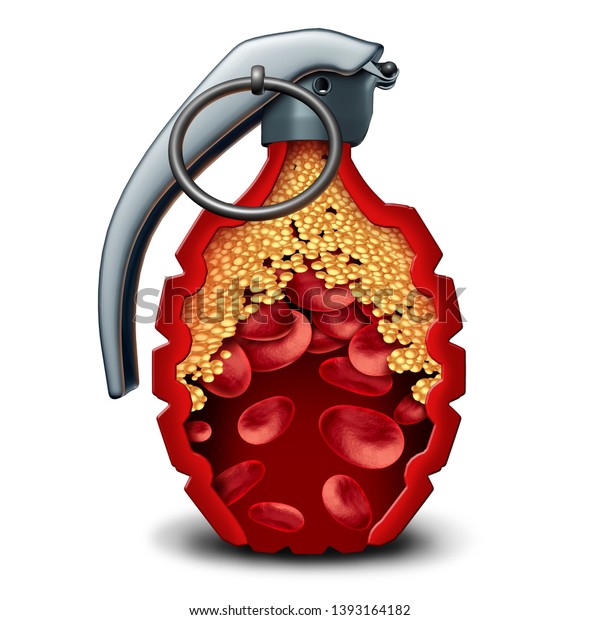 動脈に詰まったプラーク形成と3dイラストのアテローム性動脈硬化を伴う 動脈内に生の手榴弾を持つ 心臓病爆弾とコレステロールの危険性冠動脈疾患 の イラスト素材