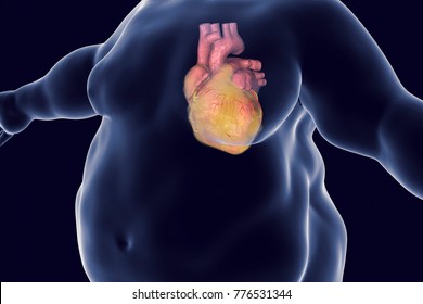 Heart Disease In A Person With Obesity, Conceptual Image. 3D Illustration Showing Increased Weight Male With Obese Heart