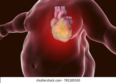 Heart Disease In A Person With Obesity, Conceptual Image. 3D Illustration Showing Increased Weight Male With Obese Heart