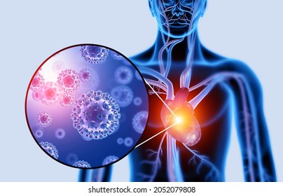 Heart Disease. Viral Infection. 3d Illustration