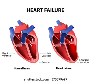 Heart Failure Or Congestive Heart Failure
