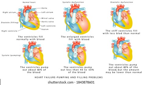 Heart Failure - Pumping And Filling Problems,  Systolic Dysfunction, Diastolic Dysfunction. Heart Failure Or Congestive Heart Failure. Diseases Of The Heart