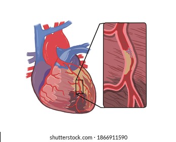 2,034 Heart attack diagram Images, Stock Photos & Vectors | Shutterstock