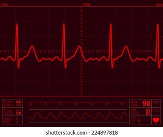 Heart Monitor Screen With Normal Beat Signal
