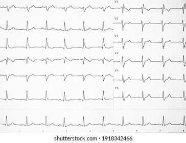 Heart rate on paper for recording an electrocardiogram, prevention of heart diseases. Electrocardiogram strips with cardiac arrhythmias. Alterations of heartbeats represented on paper. Copy space.