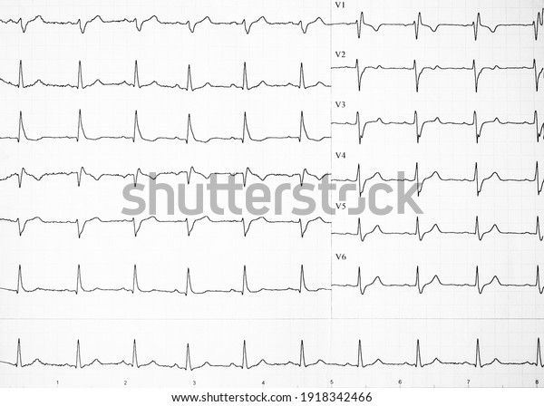 心電図記録用紙の心拍数や心臓病の予防 心不整脈を呈する心電図帯 ハートビートの変更は紙に表示 スペースをコピーします のイラスト素材