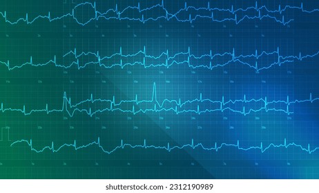 
heart rhythm control chart blue background - Powered by Shutterstock