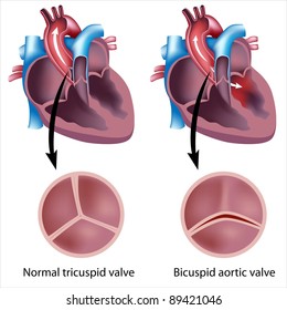 6,258 Heart valve diseases Images, Stock Photos & Vectors | Shutterstock