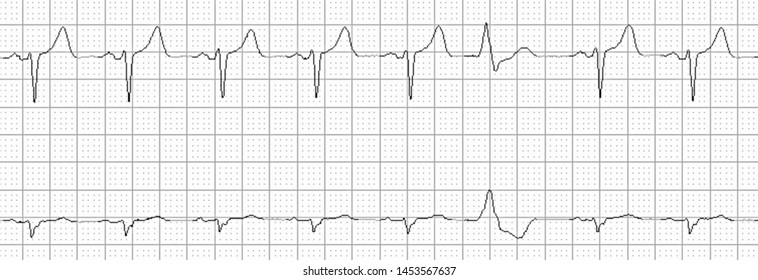 Abnormal Ekg Images, Stock Photos & Vectors | Shutterstock