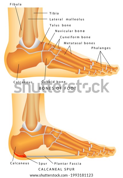 Heel Spur. Bones of\
the Foot and Ankle. Calcaneal spur. Calcaneal spur a bone\
excrescence on the lower surface of the calcaneus which frequently\
causes pain on\
walking.