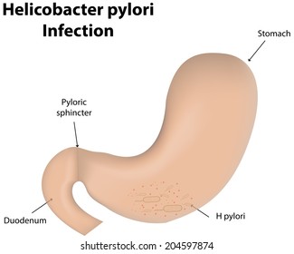 Helicobacter Pylori Infection