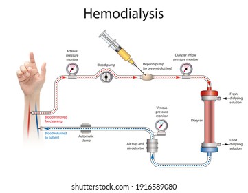 Hemodialysis or simply dialysis, is a process of purifying the blood of a person whose kidneys are not working normally
