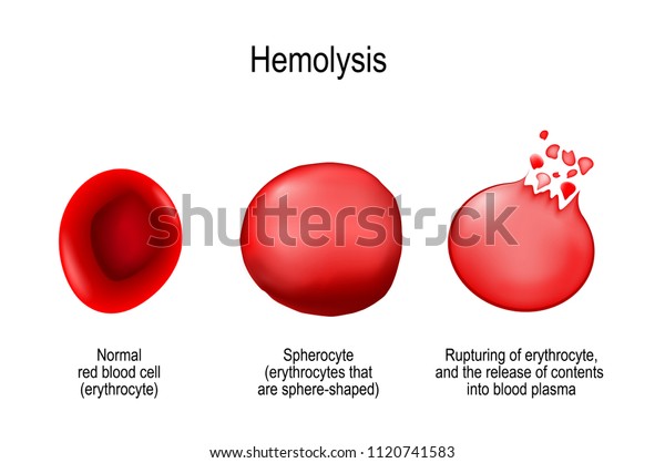 溶血 赤血球の正常な赤血球 球状細胞 破裂 血漿中への内容物の放出 医療用イラスト のイラスト素材