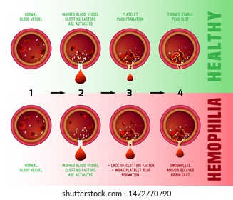 Hemophilia Blood Clotting Stages Vessel Cuts Stock Illustration ...