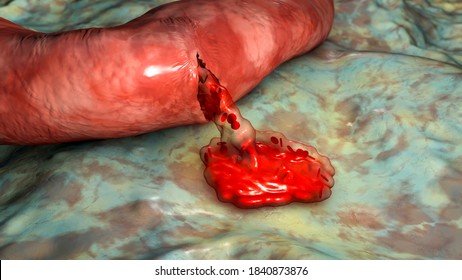 Hemorrhage, Blood Flowing From The Damaged Blood Vessel, 3D Illustration. Hemorrhagic Stroke, Traumatic Injury Or Other Diseases With Bleeding